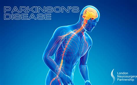 Parkinson's disease. 